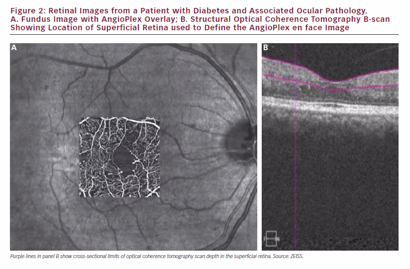 Retinal vascular assessment in psoriatic patients with and without metabolic syndrome using optical coherence tomography angiography