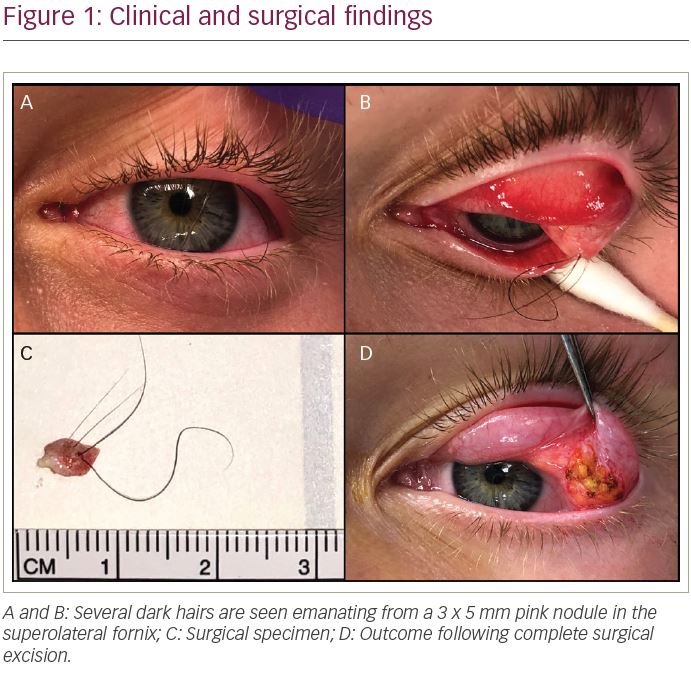 Trichofolliculoma of the Palpebral Conjunctiva: A Case Report -  touchOPHTHALMOLOGY